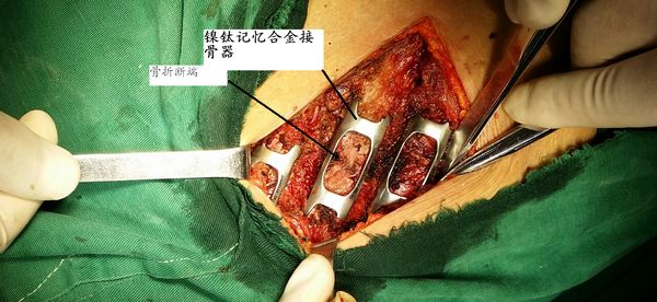 胸脑外科新技术——镍钛记忆合金环抱器治疗多发性肋骨骨折
