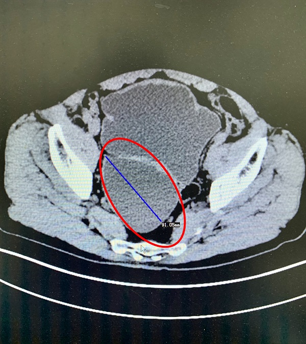 术前膀胱憩室图片.JPG