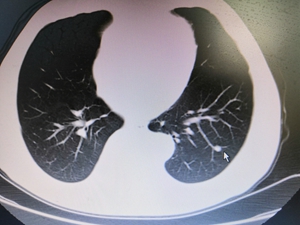 第三个病历 患者，男，66岁，系体检发现磨玻璃样小结节，患者无吸烟史，CT提示：左肺下叶后基底段小结节，境界尚清，大小6乘以5mm。患者由2017年至2020年定期随访_副本.jpg