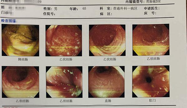 四两拨千斤 | 普外科一病区利用电子肠镜为一位老年患者成功复位急性