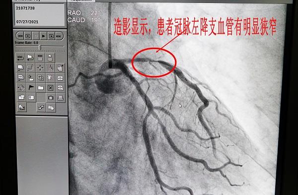 3.通过DSA心脏造影，确诊患者心脏左降支血管明显狭窄-600.jpg
