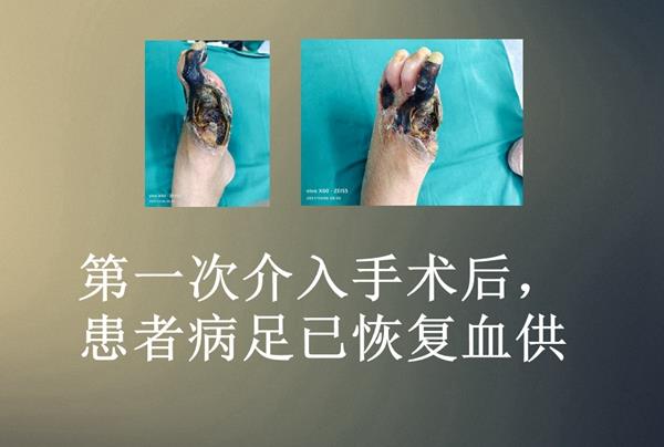 4 坏死病足_副本_副本_副本.jpg 4 坏死病足_副本_副本_副本.jpg