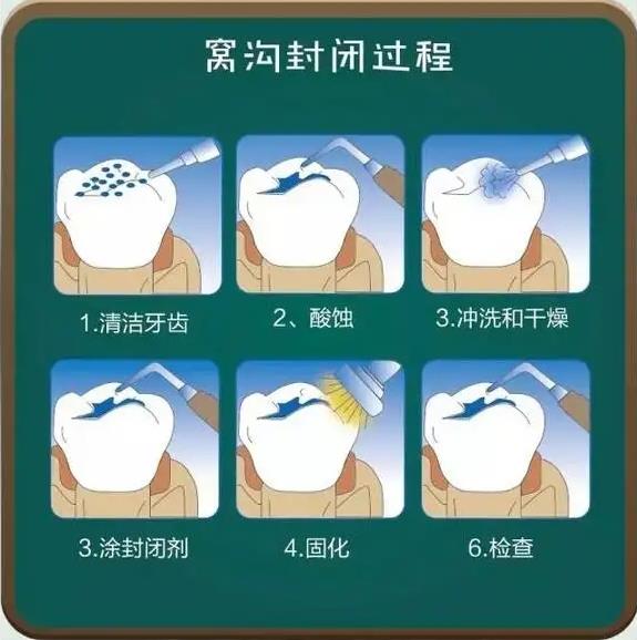 窝沟封闭过程.jpg 窝沟封闭过程.jpg