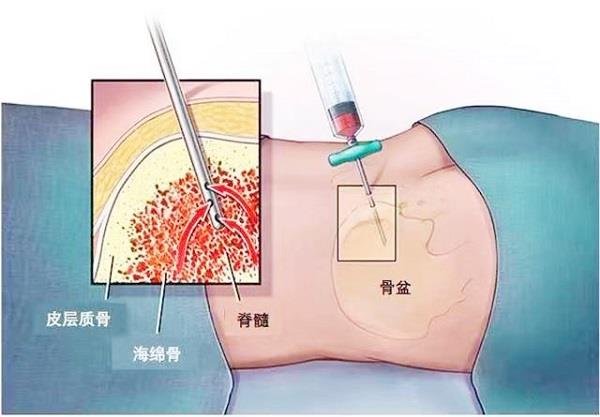 骨髓穿刺示意图 骨髓穿刺示意图.jpg