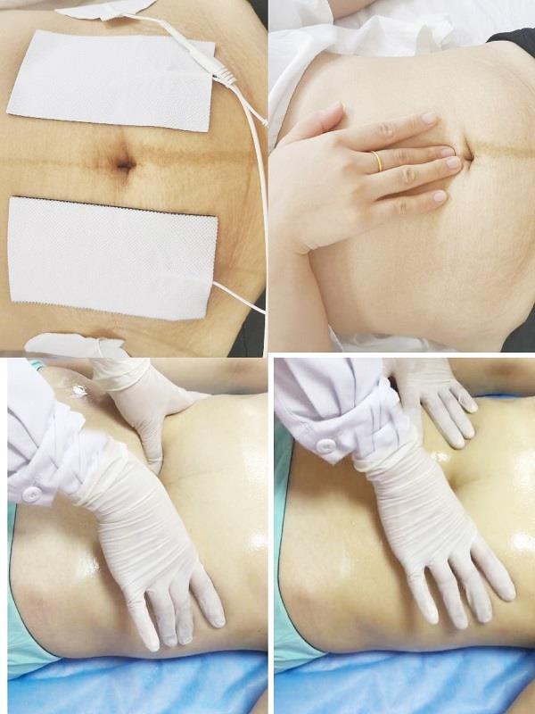 腹直肌分离治疗 腹直肌分离治疗.jpg