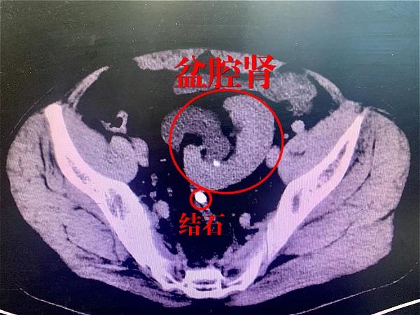 盆腔肾、结石 盆腔肾、结石.jpg