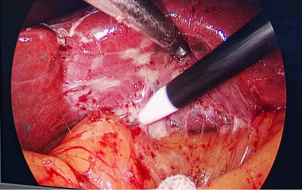 2.术中见患者腹腔内严重粘连 2.术中见患者腹腔内严重粘连.png