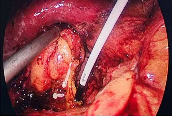 3.术中经胆囊管置入超细胆道镜 3.术中经胆囊管置入超细胆道镜.png