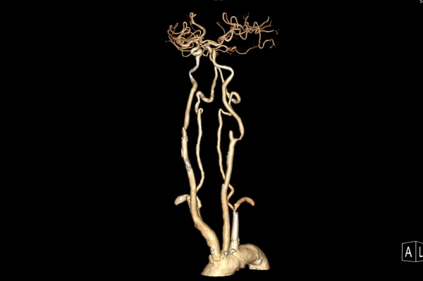 术前CTA 术前CTA.png