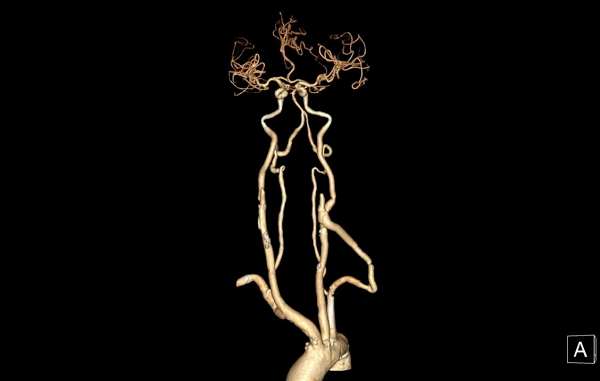 术后CTA 术后CTA.png