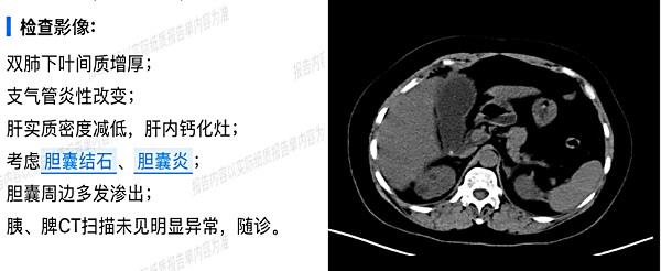 图1 CT提示胆囊结石伴胆囊周边渗出。 图1 CT提示胆囊结石伴胆囊周边渗出。.jpg